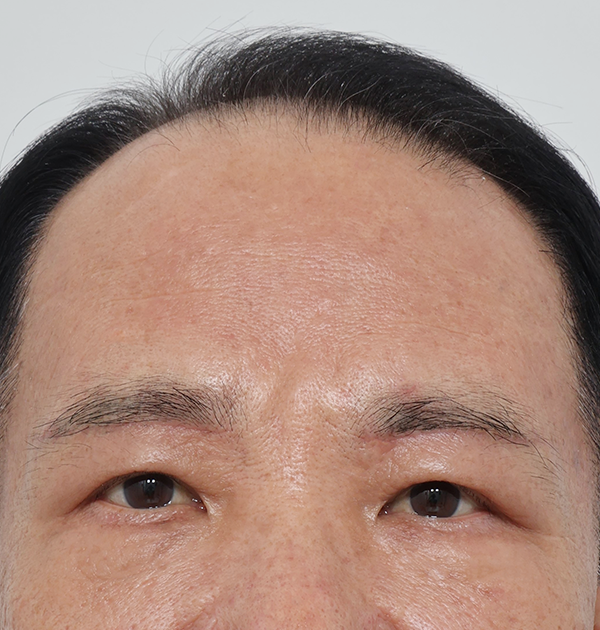 [상안검 + 하안검 지방재배치 + 눈썹하거상] 후