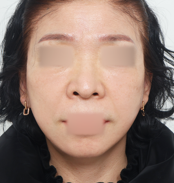[안면거상 + 목거상 + 심부볼지방재배치] 후