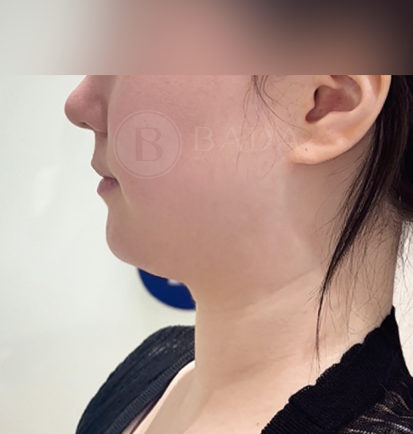 [이중턱 근육묶기 + 이중턱 지방흡입] 전