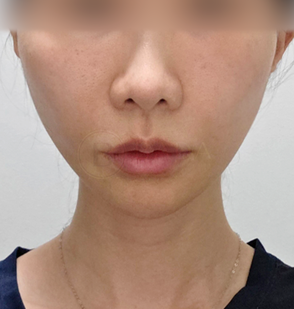 [하안면 미니거상 + 얼굴지방이식(팔자, 옆볼)] 후