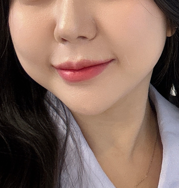 [심부볼지방제거 + 볼지방흡입] 전