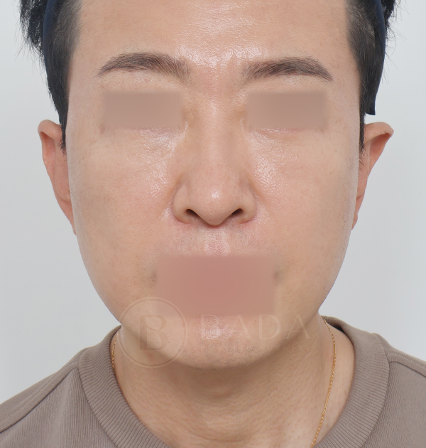 [남자 중하안면 미니거상 + 하안검 지방재배치] 후