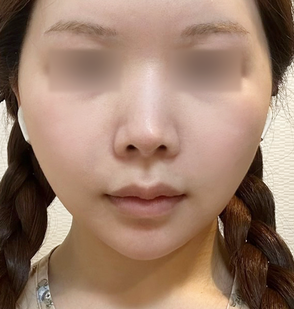 [중하안면 미니거상 + 얼굴지방재배치] 후