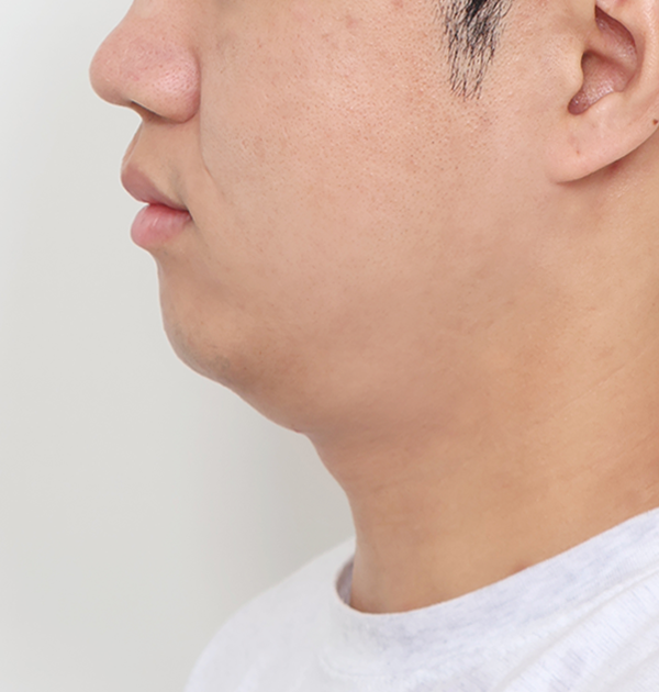 [이중턱근육묶기 + 얼굴지방흡입(이중턱, 양볼)] 전