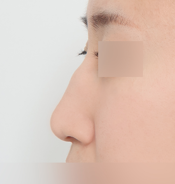 [무보형물 코성형 (비중격&귀연골 + 매부리 교정 + 휜코 교정)] 전