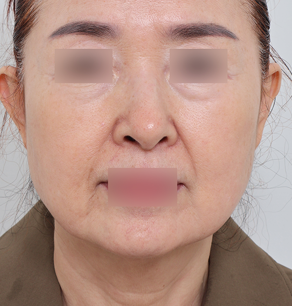 [안면거상 + 얼굴지방재배치] 전