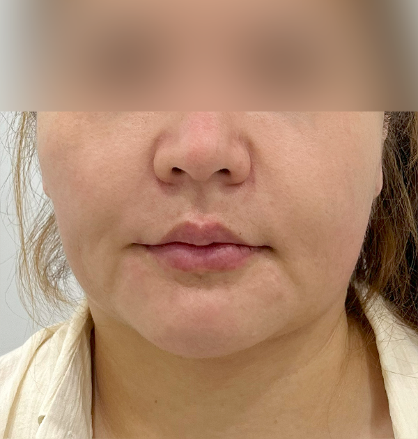 [하안면 미니거상 + 심부볼지방재배치] 전