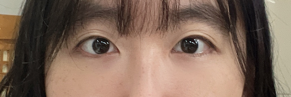 [눈밑지방재배치 + 눈밑미세지방이식] 후
