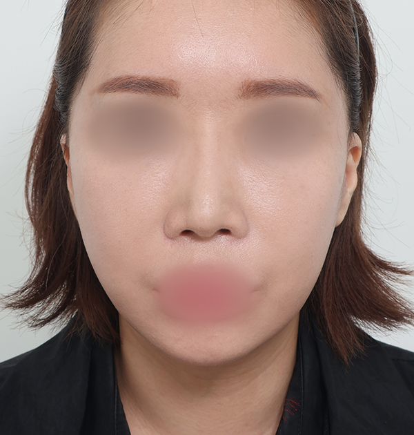 [중하안면 미니거상 + 심부볼지방재배치 + 이중턱지방흡입] 후