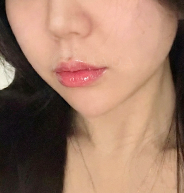 [심부볼지방제거 + 볼지방흡입] 후