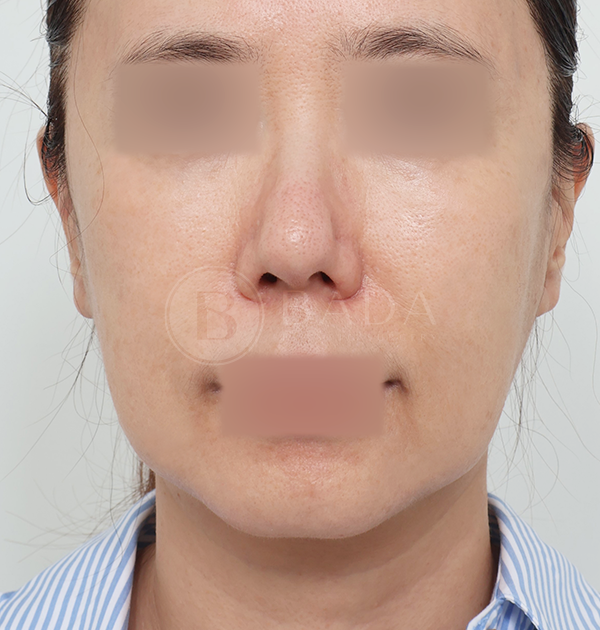 [딥플레인 안면거상 + 목거상 + 얼굴지방재배치] 전
