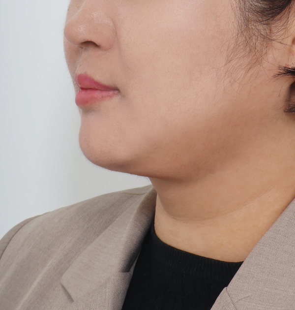 [엘라스티꿈 목리프팅 + 이중턱근육묶기 + 지방흡입] 후