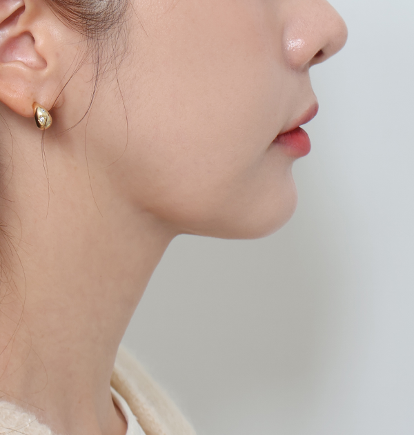 [엘라스티꿈 목리프팅 + 지방흡입(이중턱, 양볼) + 민트실리프팅] 후