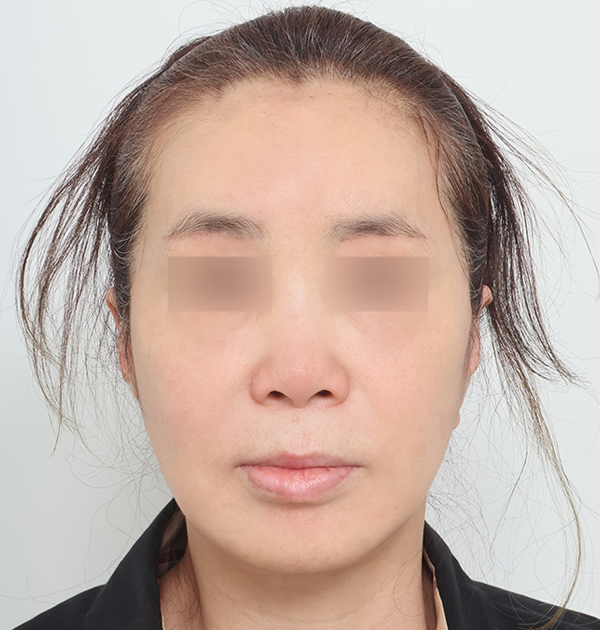 [안면거상 + 목거상 + 얼굴지방재배치 + 지방이식] 후