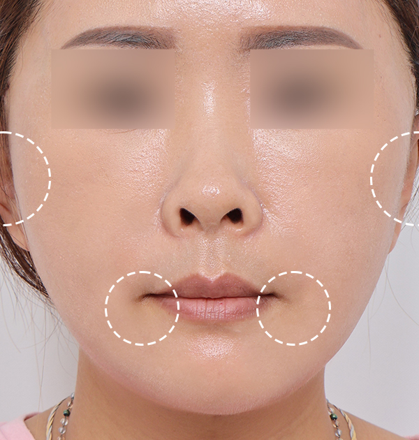 [중하안면 미니거상 + 얼굴지방재배치] 후