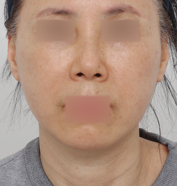 [딥플레인 안면거상 + 목거상 + 얼굴지방재배치] 후