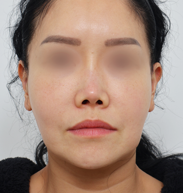 [중하안면 미니거상(재수술) + 얼굴지방재배치] 전