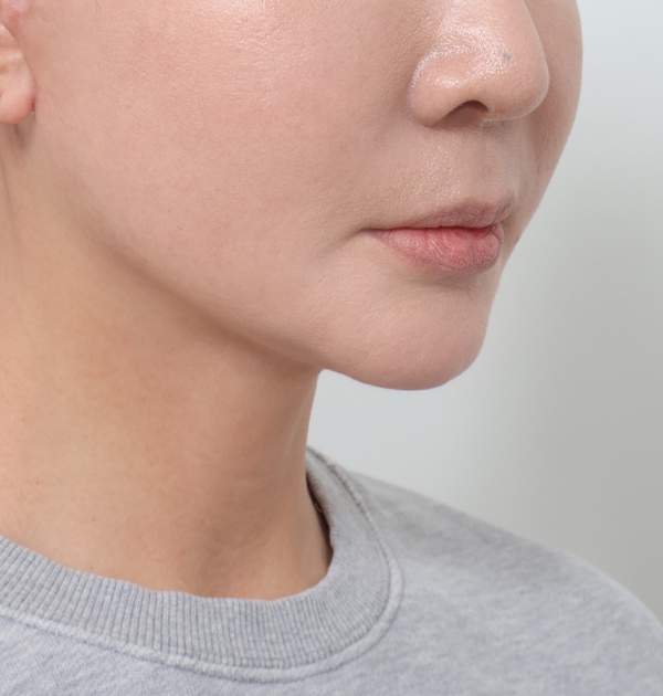 [중하안면 미니거상 + 얼굴지방재배치] 후