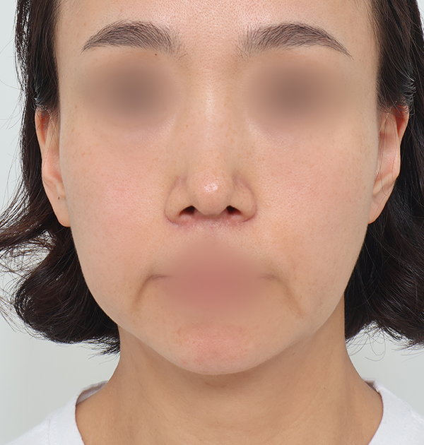 [중하안면 미니거상 + 심부볼지방재배치 + 지방이식] 전