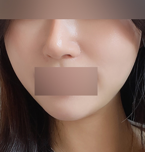 [이중턱지방흡입 + 근육묶기 + 양볼지방흡입] 후