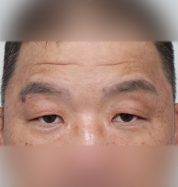 [이마거상 + 상안검 눈매교정] 전