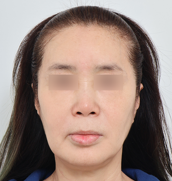 [안면거상 + 목거상 + 얼굴지방재배치 + 지방이식] 전