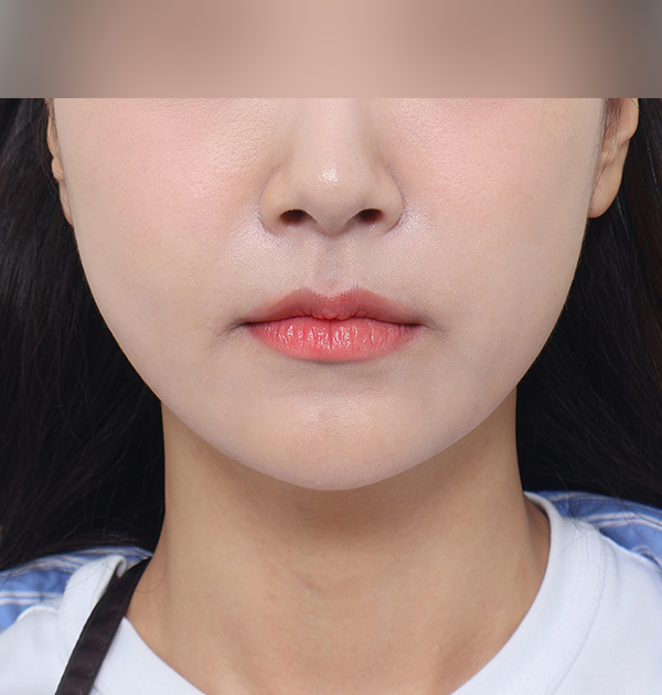 [민트실리프팅] 후