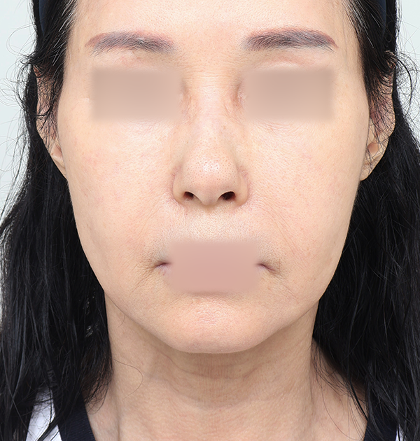 [중하안면 미니거상] 전