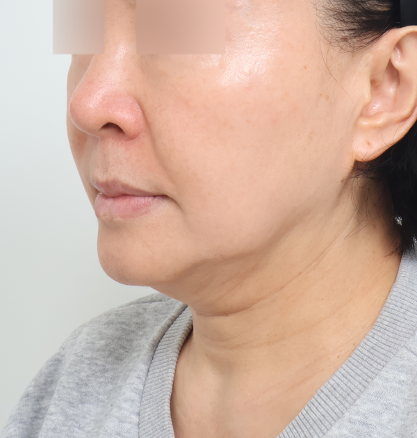[안면거상 + 목거상 + 심부볼지방재배치] 전