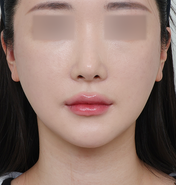 [중안면 미니거상 + 심부볼지방제거 + 보형물 제거(귀족)] 후