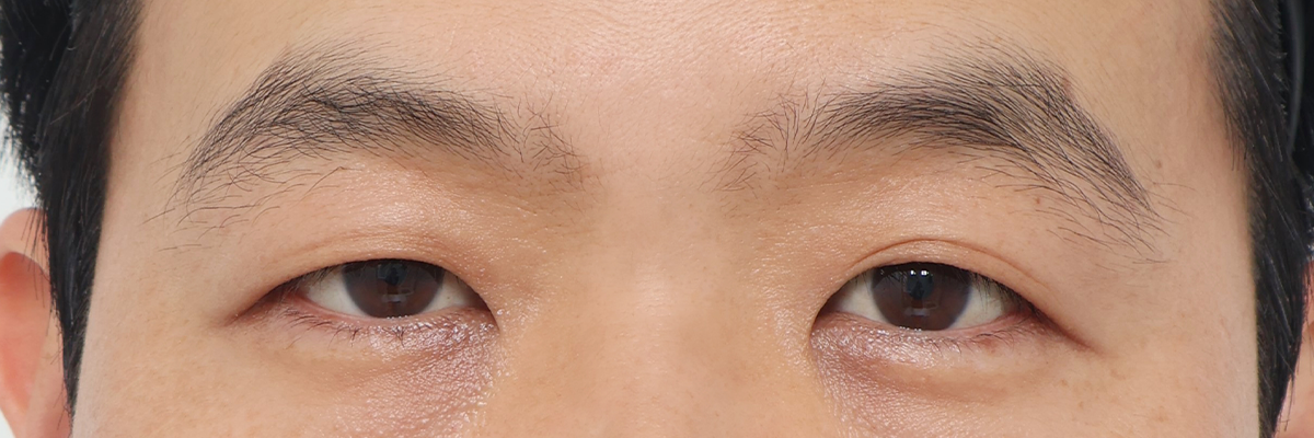 [절개 + 눈매교정] 전