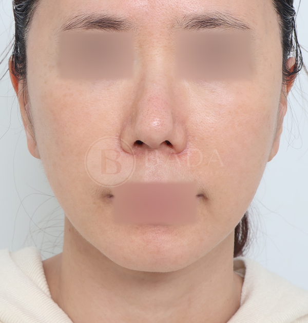 [딥플레인 안면거상 + 목거상 + 얼굴지방재배치] 후