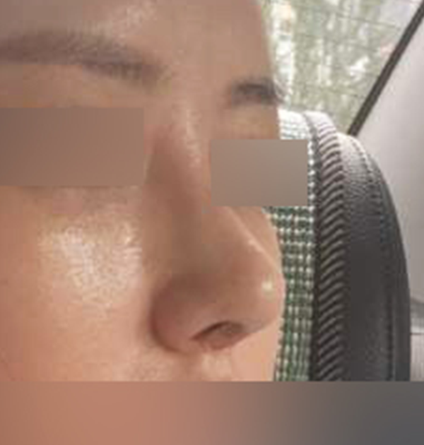 [기능코성형(비중격만곡증 + 매부리 교정 + 복코)] 후