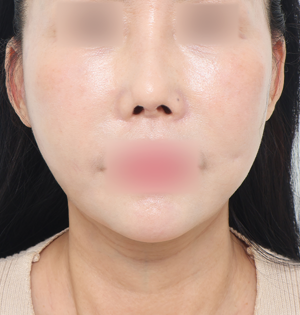 [중하안면 미니거상] 후