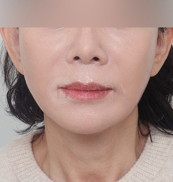 [딥플레인 안면거상 + 목거상 + 얼굴지방재배치] 후