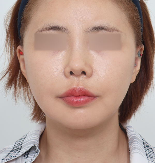 [중하안면 미니거상 + 심부볼지방재배치] 후