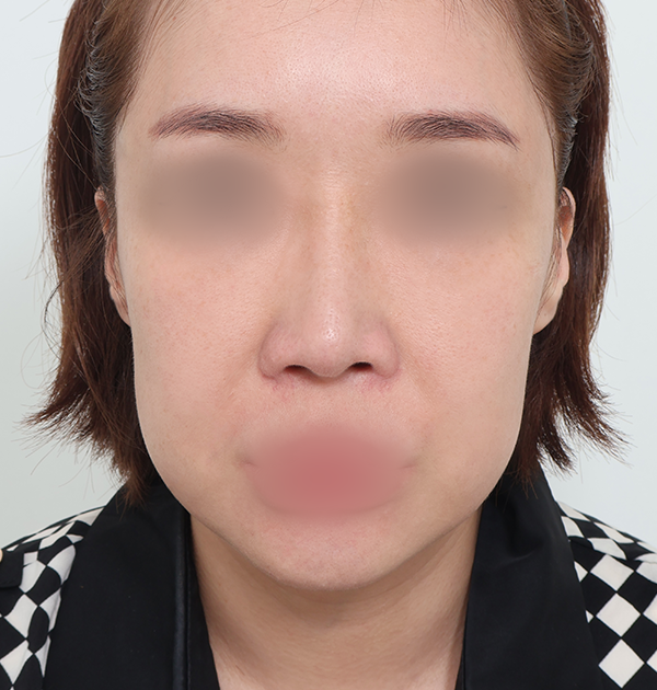 [중하안면 미니거상 + 심부볼지방재배치 + 이중턱지방흡입] 전