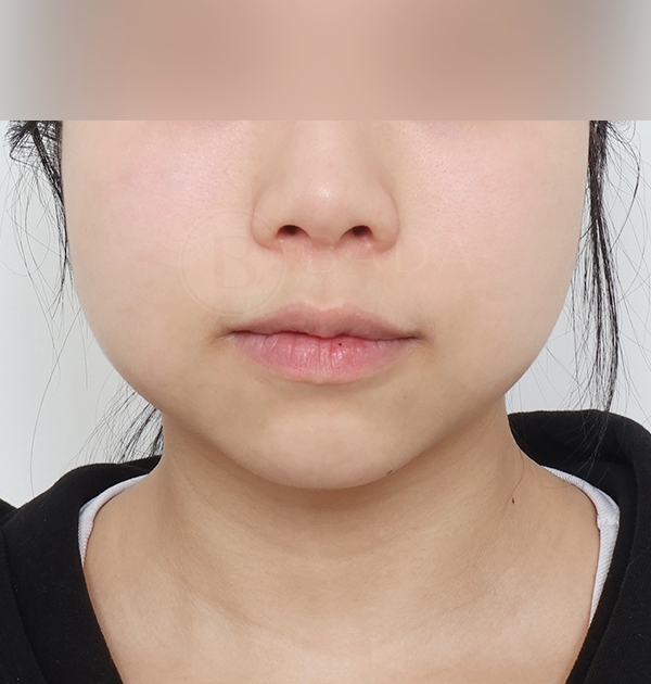 [심부볼제거 + 볼 지방흡입 + 턱끝 필러] 전