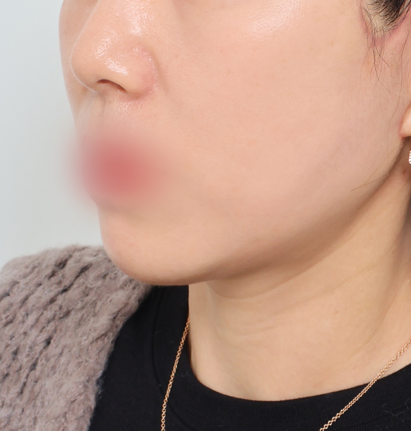[안면거상 + 심부볼지방재배치] 후