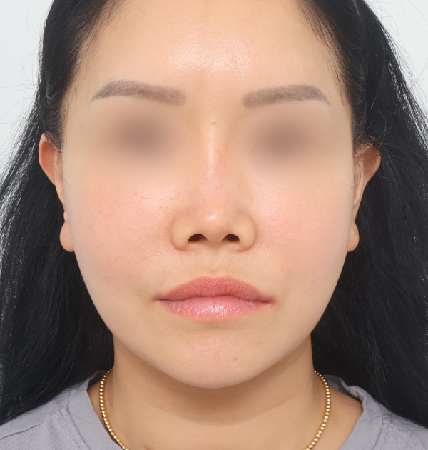 [중하안면 미니거상(재수술) + 얼굴지방재배치] 후