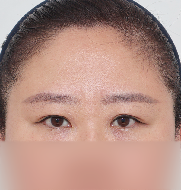 [이마거상 + 이물질제거] 전