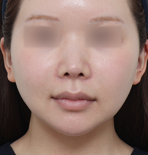 [중하안면 미니거상 + 얼굴지방재배치] 전
