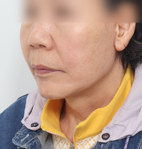 [안면거상 + 목거상 + 얼굴지방재배치 + 근막이식] 후