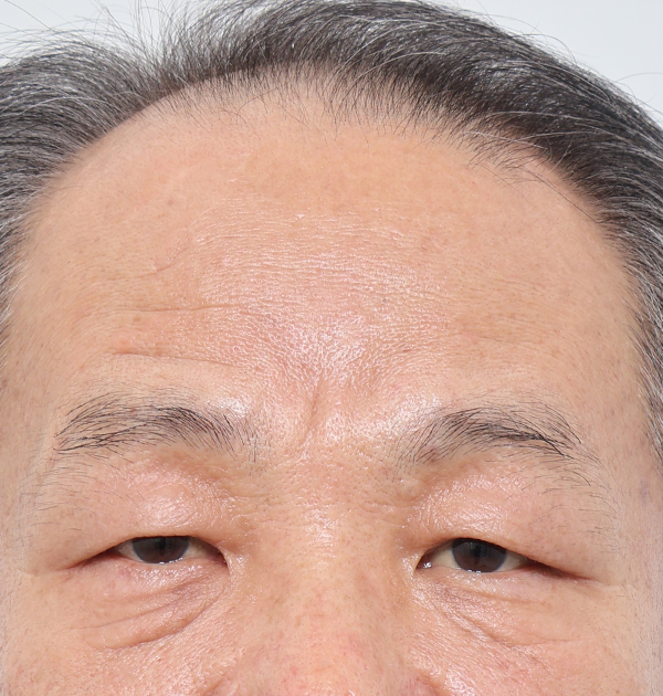 [상안검 + 하안검 지방재배치 + 눈썹하거상] 전