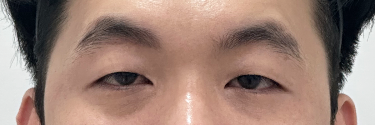 [절개 + 눈매교정] 전