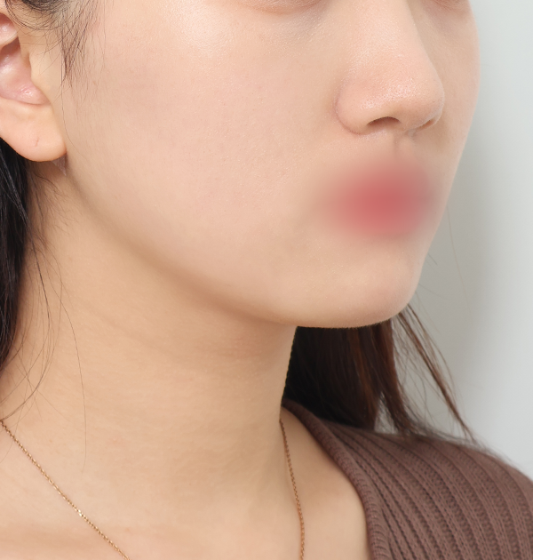 [이중턱&양볼지방흡입] 후
