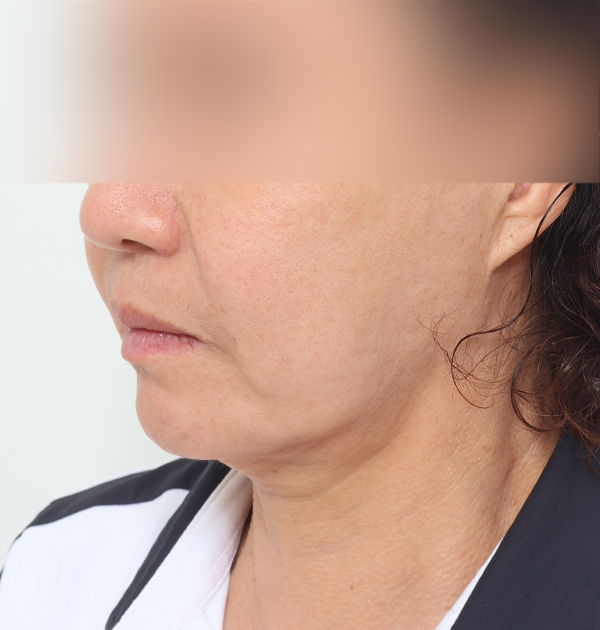 [안면거상 재수술 + 목거상 + 얼굴지방재배치] 전