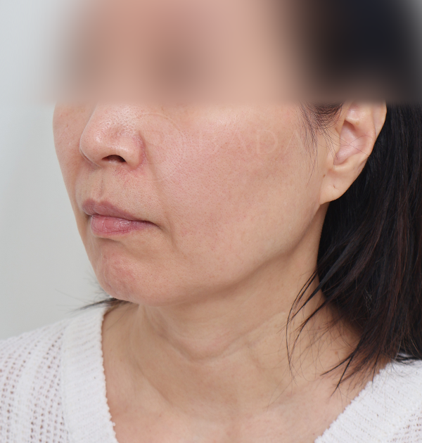 [중하안면 미니거상] 전