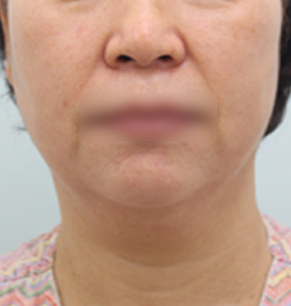 [중하안면 미니거상 + 이중턱근육묶기] 전