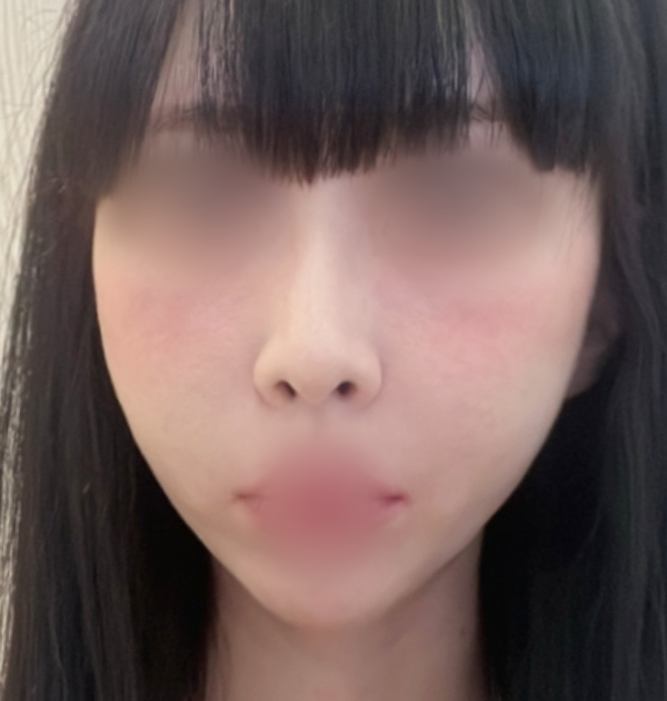 [중안면 미니거상 + 지방흡입(마리오넷, 심술보)] 후